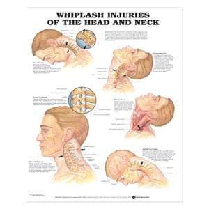 Whiplash Injuries Head/Neck 20x26" Educational Chart Ea