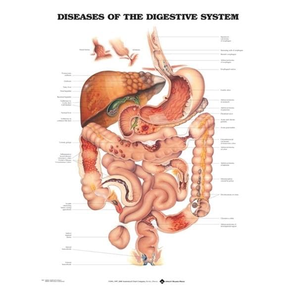 Diseases of The Digestive System 20x26" Educational Chart Ea