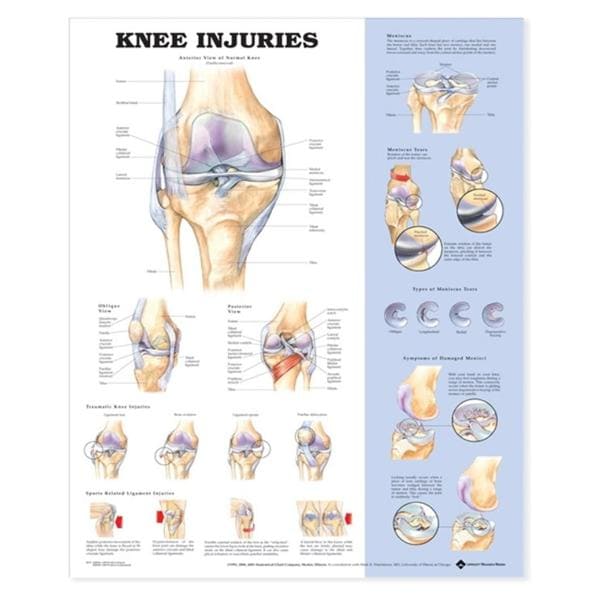 Knee Injuries 20x26" Anatomical Chart Ea