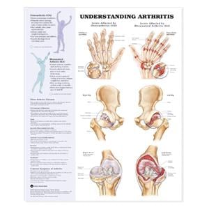 Arthritis/Joint 20x26" Anatomical Chart Ea