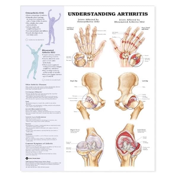 Arthritis/Joint 20x26" Anatomical Chart Ea