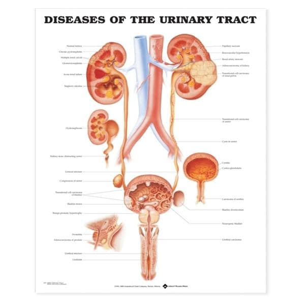 Diseases of Urine Tract 20x26" Educational Chart Ea