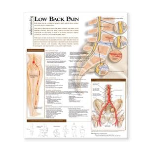 Understanding Low Back Pain 20x26" Anatomical Chart Ea