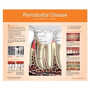 Poster Periodontal Disease 16 in x 20 in With Lamination Ea