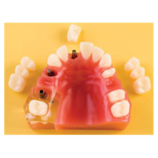 Patient Education Model Implant / Crown and Bridge Ea