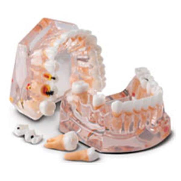 Patient Education Model Caries Evolution 3.5 in x 4.25 in Ea