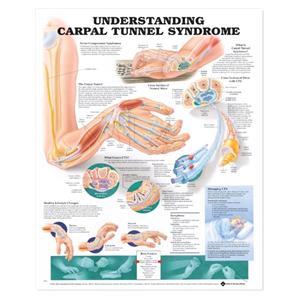 Understanding Carpal Tunnel Syndrome 20x26" Educational Chart Ea