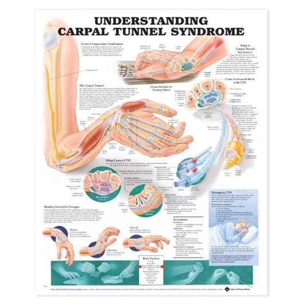 Understanding Carpal Tunnel Syndrome 20x26" Educational Chart Ea