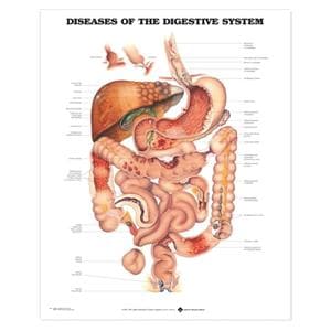 Diseases of The Digestive System 20x26" Educational Chart Ea